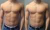 Impending_Gynecomastia,_Puffy_Nipples.jpg