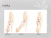 valgus.jpg